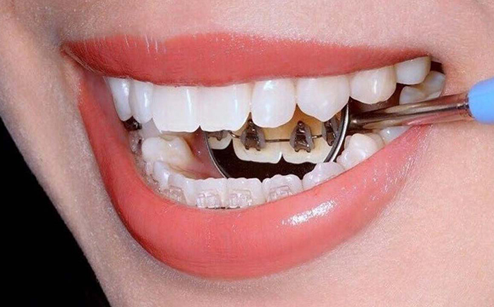 مزایا و معایب ارتودنسی لینگوال