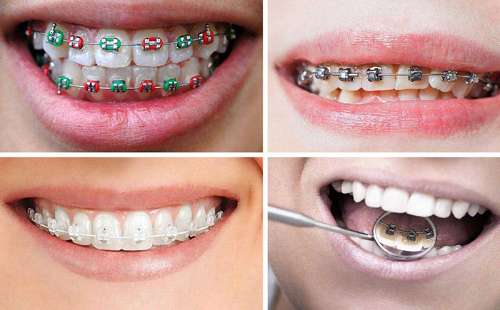 انواع روش‌های ارتودنسی برای بزرگسالان
