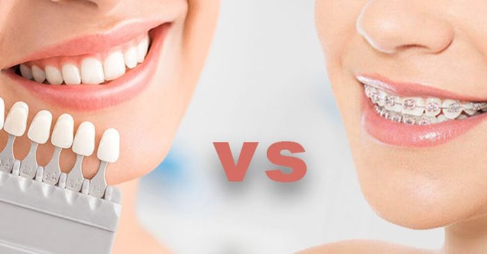 Composite-or-dental-orthodontics