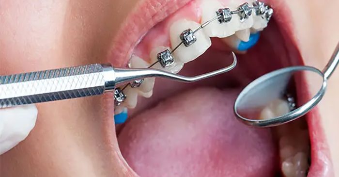 Dental-orthodontics-steps