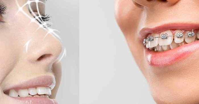 Orthodontics-or-rhinoplasty-first--Which-has-priority