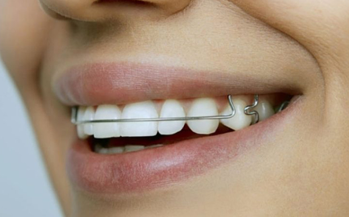 آیا بعد از ارتودنسی، نتایج درمان برمی‌گردد؟